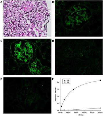 Molecular Analysis of Goodpasture’s Disease Following Hematopoietic Stem Cell Transplant in a Pediatric Patient, Recalls the Conformeropathy of Wild-Type Anti-GBM Disease